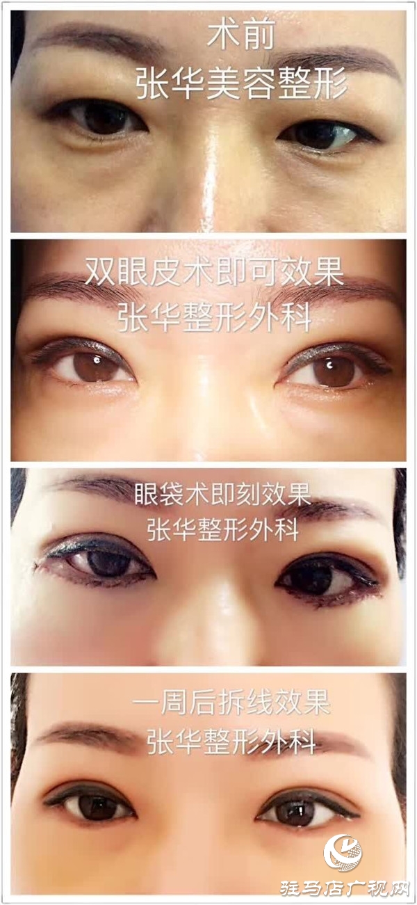 华丽蜕变 美无缺憾 张华整形让想要变美的你不再只活在美颜镜头里