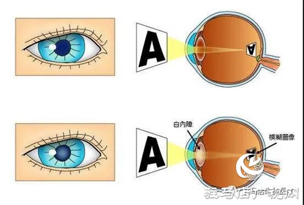  6·6爱眼日 | 关注普遍眼健康