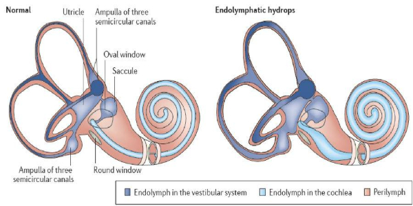 “耳水不平衡”是什么病？