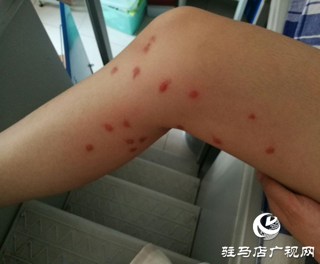 夏季被蚊虫“叮”上怎么办?皮肤科医生教你巧防治